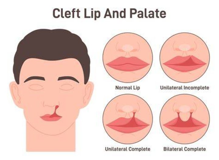 A Cleft Lip Is No Joke Why It Was Wrong for Wendy Williams to Mock